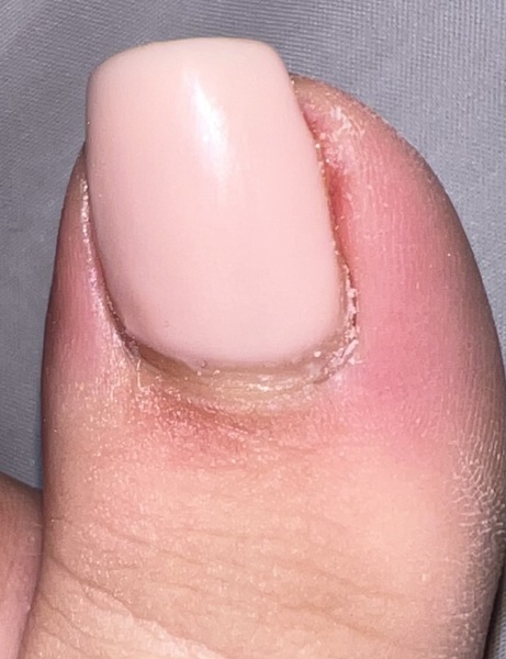 Infected toe?