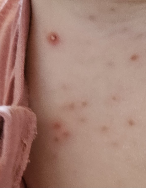 AIBU to think these chicken pox are infected