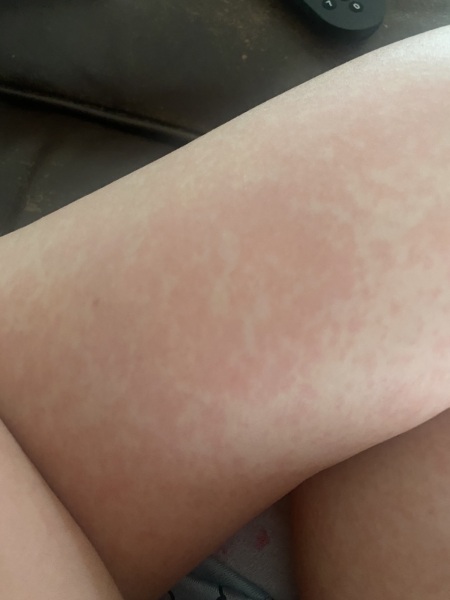 Any idea what this rash could be?