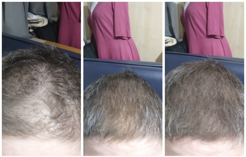Has anything worked for you against hair loss?