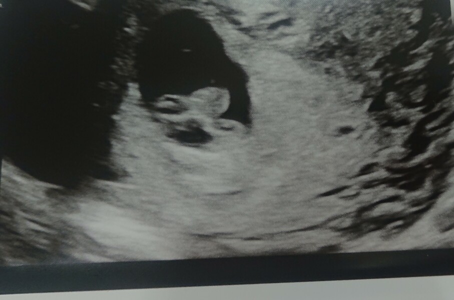 What is this on ultrasound?