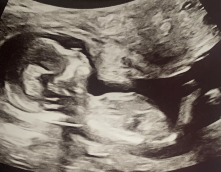 12 week scan