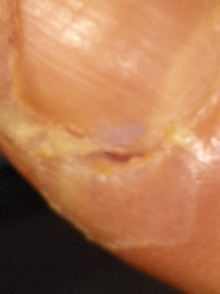 Agonising infected finger - photos.