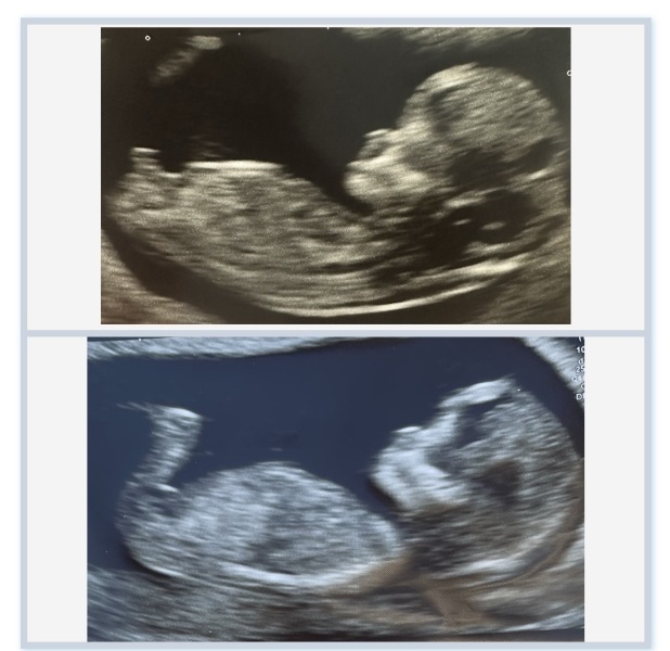 Gender Prediction fun - 12 weeks