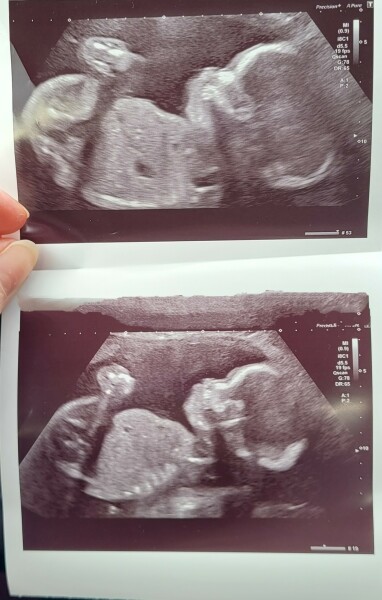 Nub guesses, 23 wk scan.