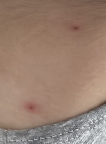 Chicken pox?
