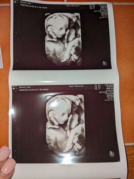 FET/IVF/ICSI Part 2