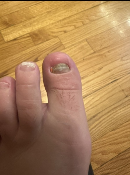 Ideas of how to disguise missing toe nail?