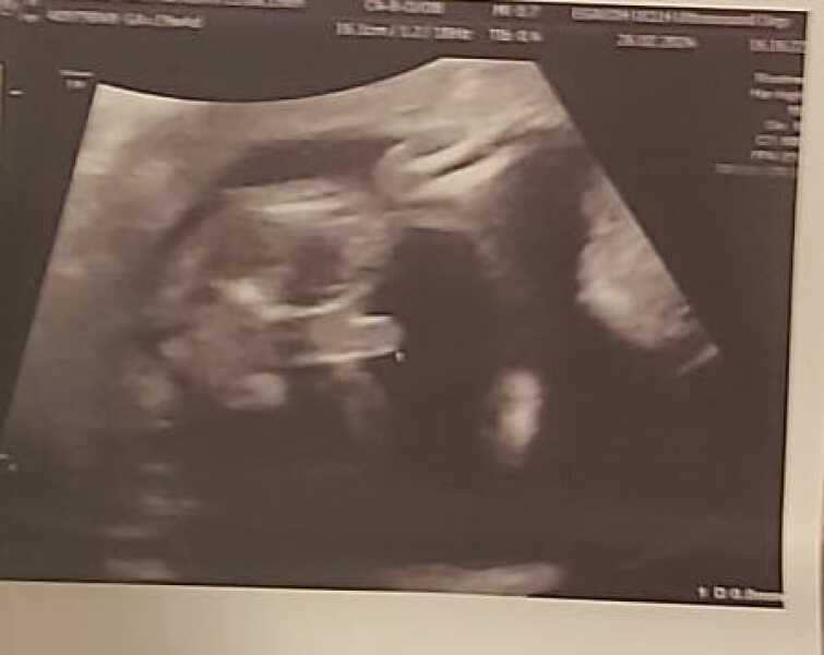 Is it a boy, girl, umbilical cord, or perhaps even fingers?
