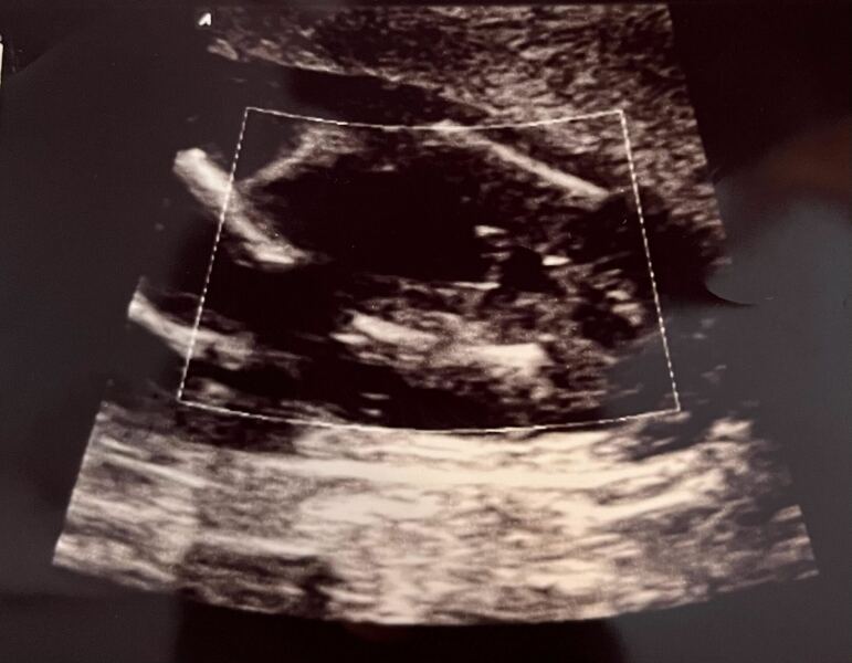 17 week scan - what do we think boy or girl?