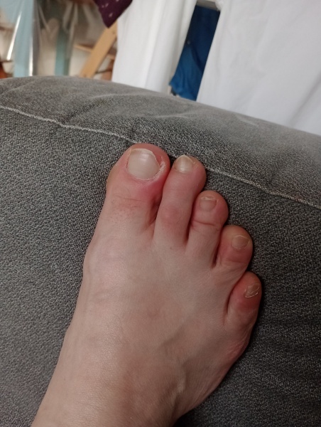 Sore toe (with pic)