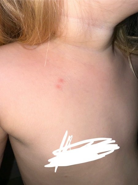 Allergy spots?