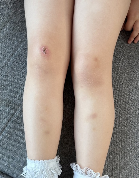 Bruised in a 4 year old