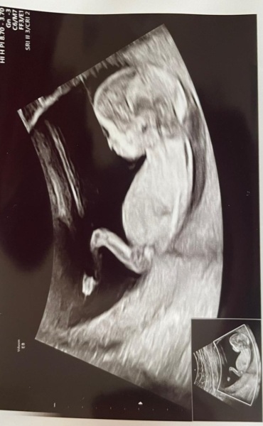 Pregnancy gender 12 week scan