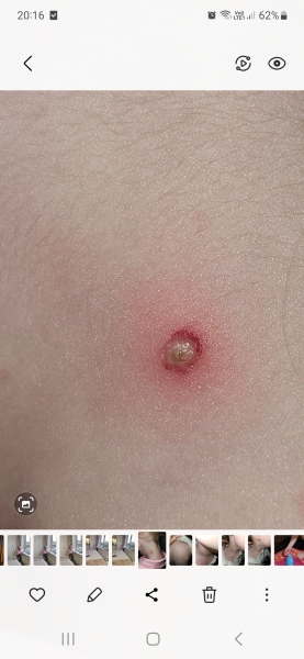 infected chicken pox??? help!!! please