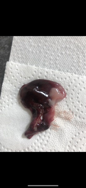 Blood clot or miscarriage