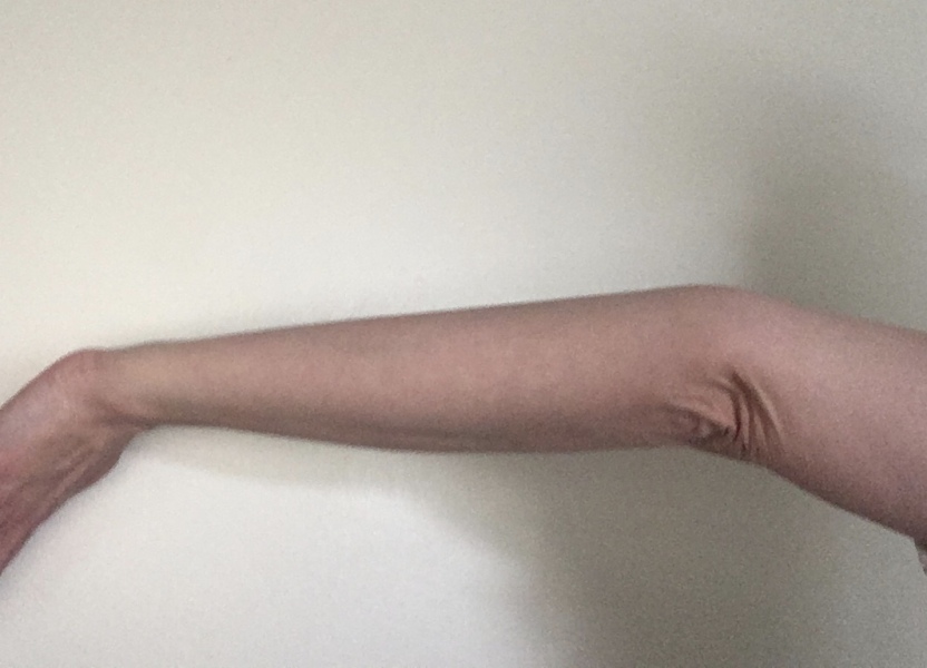 Anyone with experience of joint hypermobility or EDS?