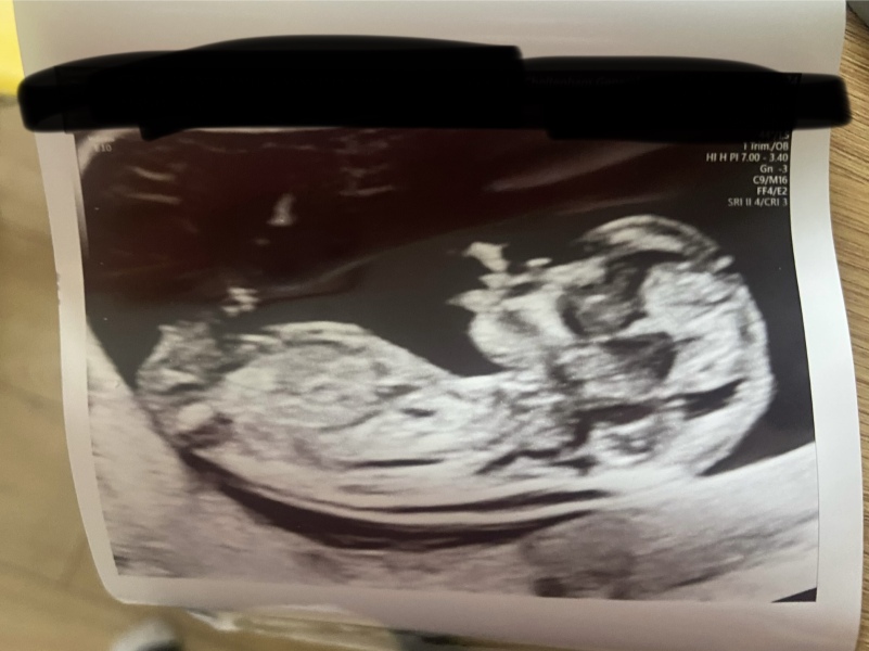 Do you want me to guess the sex? 12 week scans.