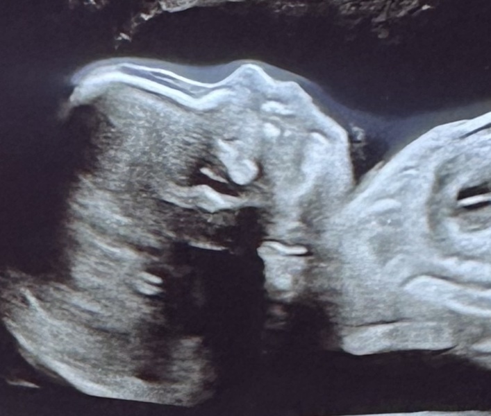 Can you see babies nasal bone