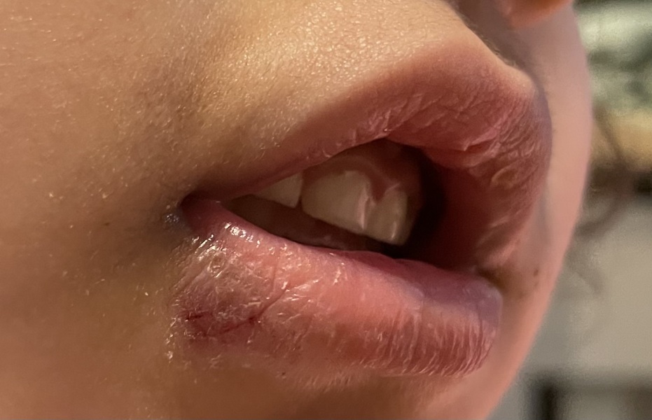 Cold sore or dry skin