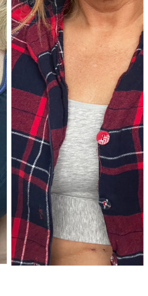 We’ve had breast reductions. Ask us anything.