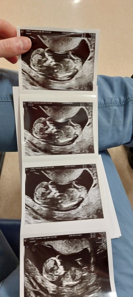 12.5 week ultrasound nub theory ??