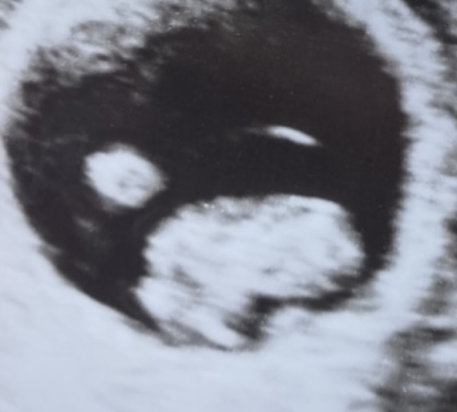 Private Scan at 8 Weeks