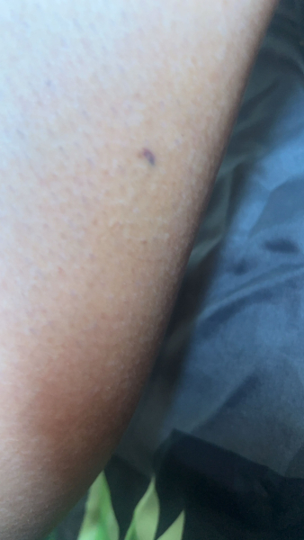 Mark on leg possible skin cancer