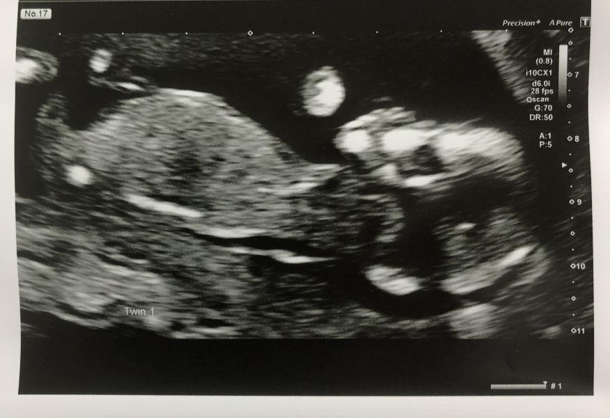 Twins due 2024