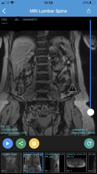 MRI scan