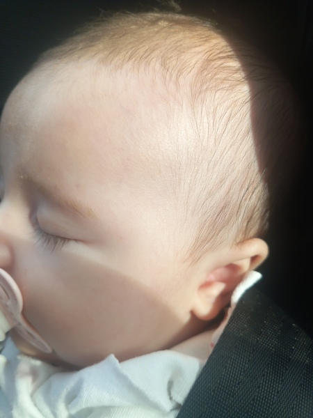 Mark on babys forehead