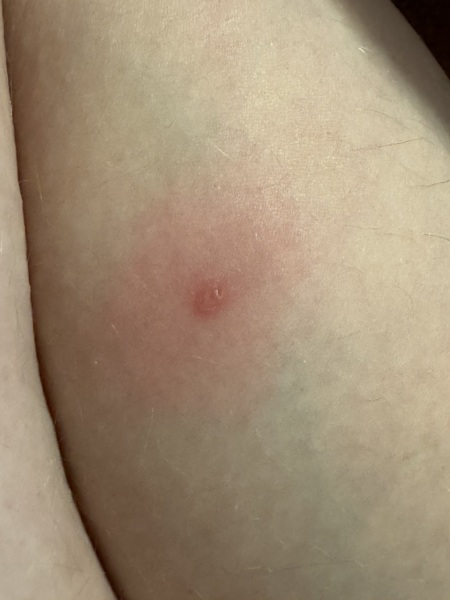 Weird painful spot on leg