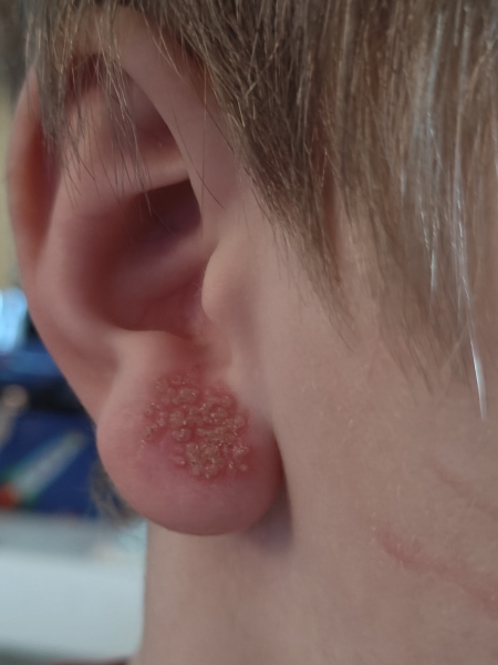 Is this a cold sore? Picture included.