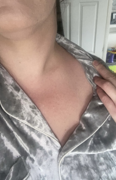 Anyone experienced anything like this is in neck?