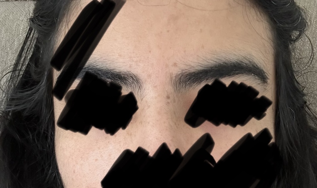 Why have I suddenly developed these “freckles”? (Pic)