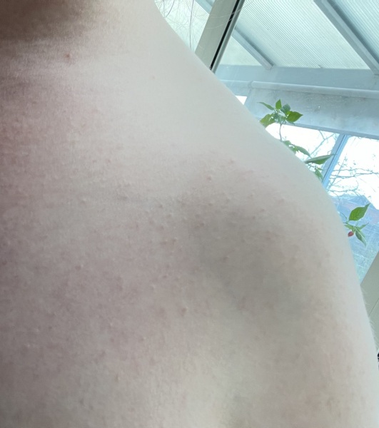 I've got this bumpy rash on my shoulder