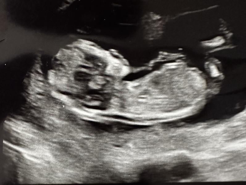 Boy or Girl?