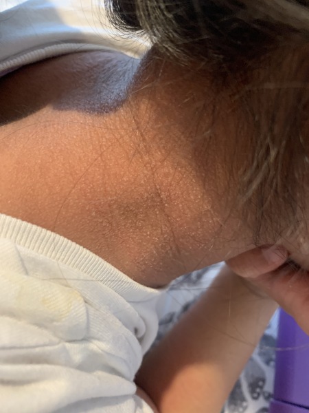 4 year old with fever and rash !