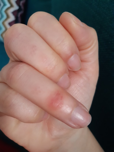 Is this Rheumatoid arthritis?