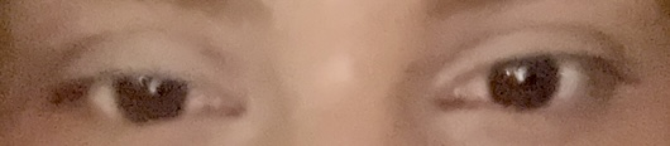 Botox gone wrong