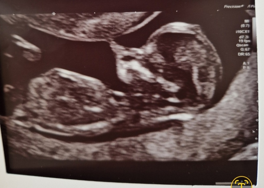 Anyone into nub theory and feeling very kind?? 12 week scan