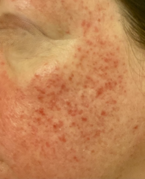 Is this lupus?
