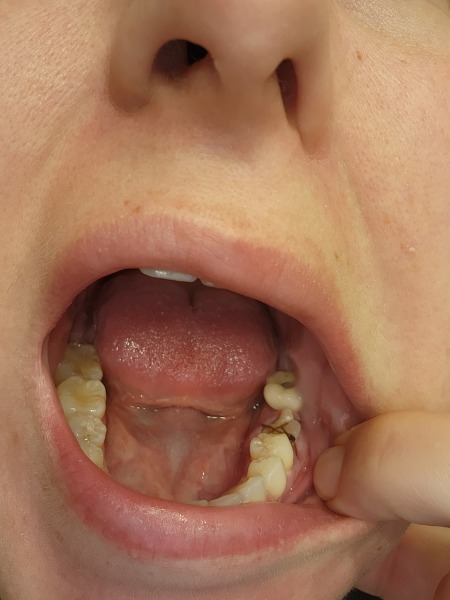 Granulation tissue, or food debris? Photo included