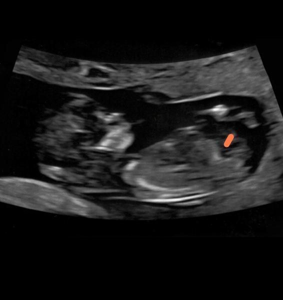 Gender Predictions!!