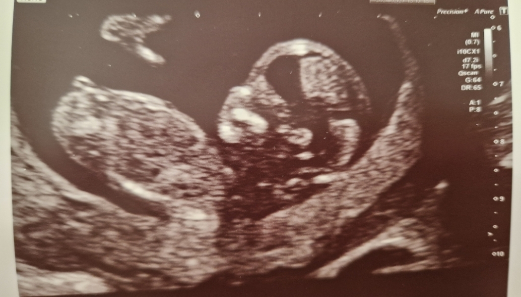 Anyone into nub theory and feeling very kind?? 12 week scan