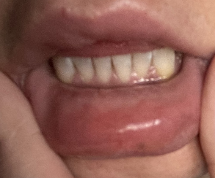 Swollen inside bottom lip for weeks