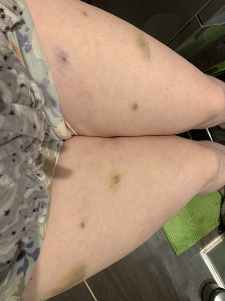 Horrific bruising with fragmin injections
