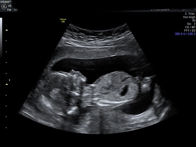 Gender scan 24th Feb! Any guesses??