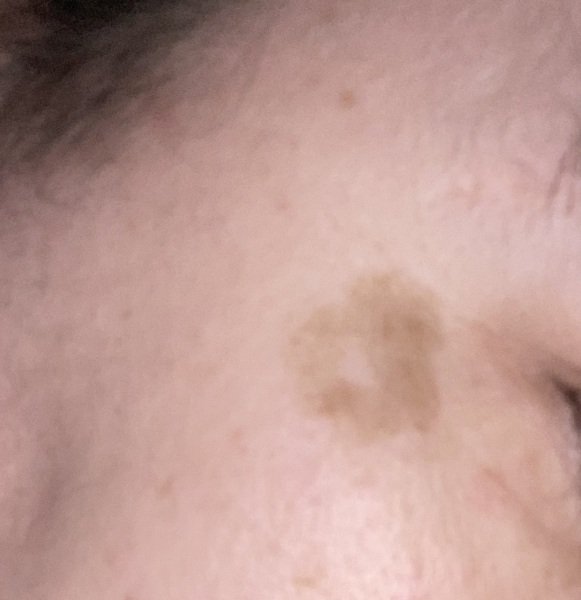 Mark on face, how to get rid.