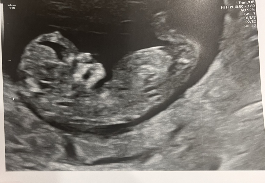 Nub theory guesses?? (12wks)